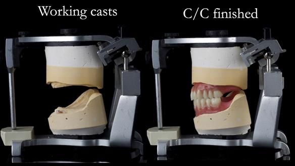 Managing poor implant positioning with complete dentures and Locator attachments - full protocol Newsletter 41