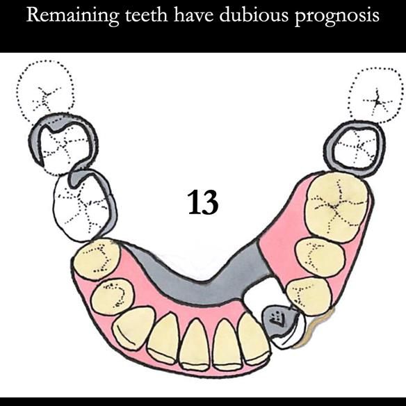 Universal Scandinavian partial denture designs