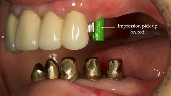 Newsletter 76: Jackie’s case – Telescopic overdenture & precision RPD (the tricky truth!)