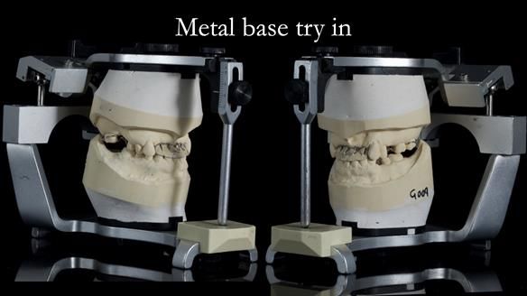 Newsletter 81 - Pam’s Story — how a partial denture changed her life (+ live walkthrough this Thursday)