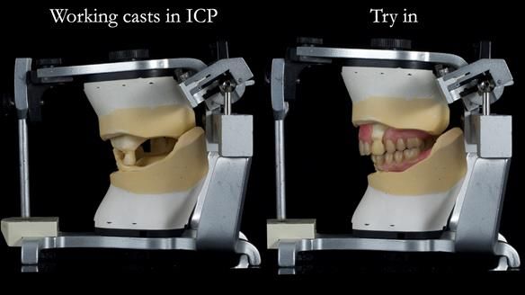 Newsletter 55 Provision of metal based partial dentures for Zephyrine with a repaired cleft lip and palate
