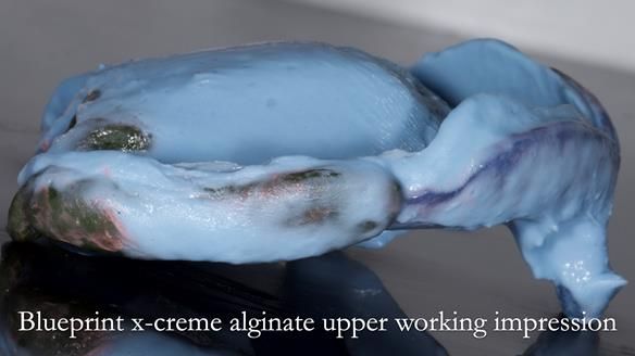 Newsletter 53 showing the making and fitting of ultra life-like dentures for Valena