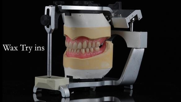 Newsletter 48 Mavis's Complete denture FULL PROTOCOL
