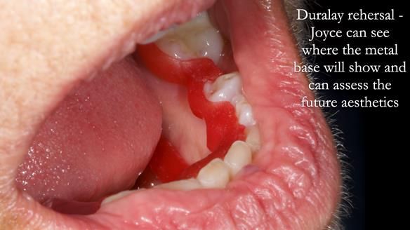 Finlay's Newsletter 61 provision of a lower unilateral free end saddle metal based partial denture for Joyce