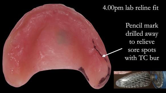 Newsletter 52 Managing Jo’s failing dentition with extractions and Mk 1/Mk 2 complete upper dentures and lower partial dentures FULL PROTOCOL