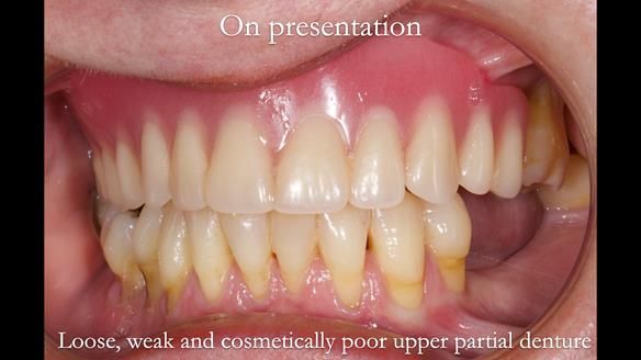 Finlay's Newsletter 58 Gasket upper partial denture for Zoe