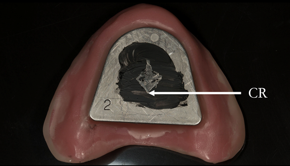 Figure 81 Central bearing apparatus to record centric relation accurately - maxillary plate. The patient has scribed an arrow shape - the apex is centric relation