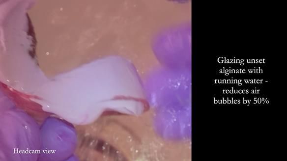 Newsletter 82 Mary - A complete upper and a one-tooth gasket denture