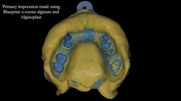 Newsletter 81 - Pam’s Story — how a partial denture changed her life (+ live walkthrough this Thursday)