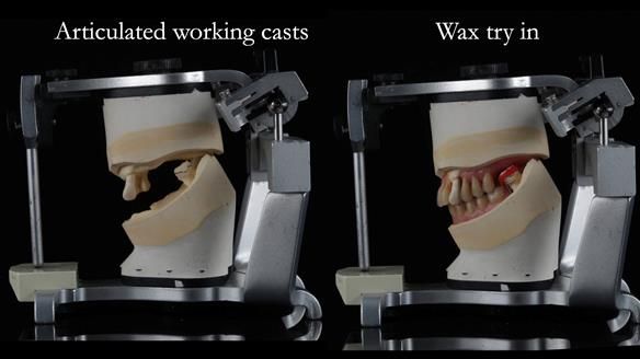 Finlay's Newsletter 59 Ultra hard partial dentures made for Gill