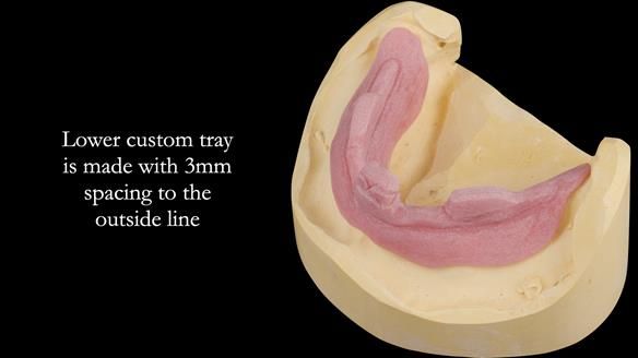 Newsletter 50 Special edition Complete Dentures FULL PROTOCOL