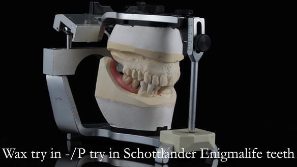 Newsletter 54 case presentation upper complete denture and lower Scandinavian designed hygienic partial denture for David