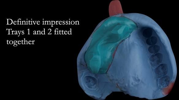 Upper metal base partial denture/occlusal stabilisation splint/obturator - full protocol
