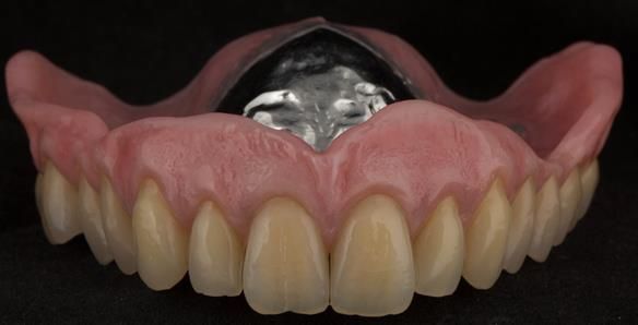 Figure 105 Mk 2 maxillary metal based denture with subtlety characterised Schottlander Enigmalife teeth. Gum colouring - Vertex