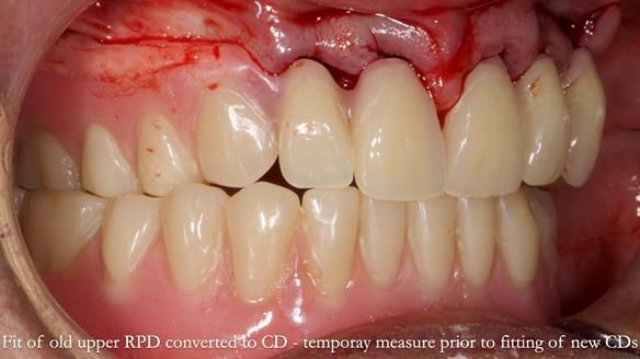 Finlay's Newsletter 62 provision of extractions and metal based complete dentures for Rafique