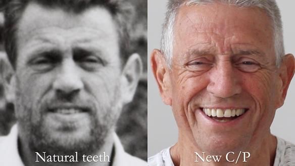 Newsletter 54 case presentation upper complete denture and lower Scandinavian designed hygienic partial denture for David