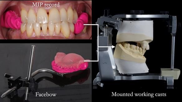Newsletter 56 showing the making and fitting of a bilateral free end saddle upper removable partial denture (RPD) for patient with pemphigus