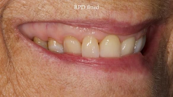 Finlay's Newsletter 61 provision of a lower unilateral free end saddle metal based partial denture for Joyce