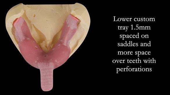 Solving Linda’s Failed “All on 4” implant bridges - full protocol Newsletter 42