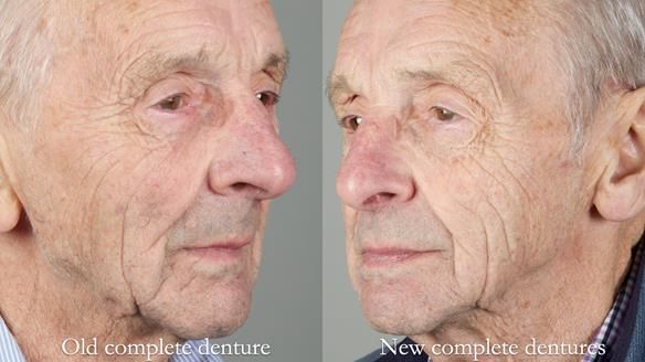 Newsletter 80 - Gordon’s dentures: the one case in 1,000 where my technique failed