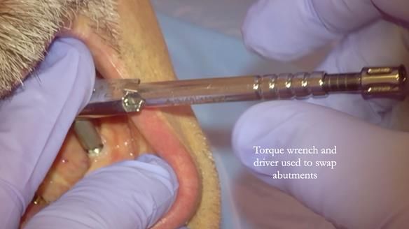 Newsletter 78: What do Clark Gable and a Locator® overdenture have in common?