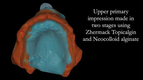 Complete denture Class II div 2 deep overbite Newsletter 39