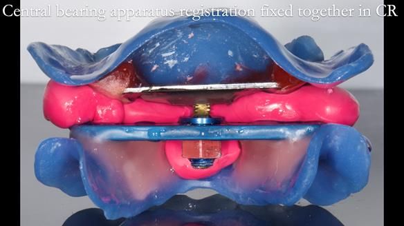 Finlay's Newsletter 62 provision of extractions and metal based complete dentures for Rafique