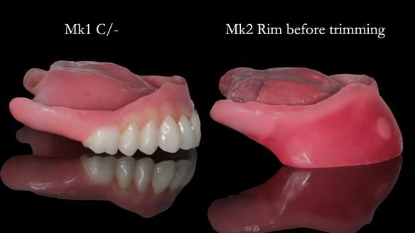 Newsletter 52 Managing Jo’s failing dentition with extractions and Mk 1/Mk 2 complete upper dentures and lower partial dentures FULL PROTOCOL