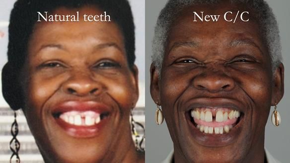 Newsletter 53 showing the making and fitting of ultra life-like dentures for Valena