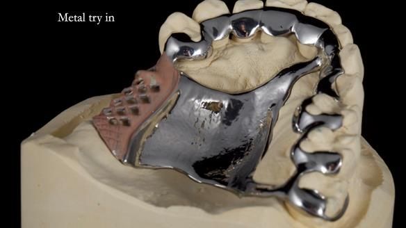 Finlay's Newsletter 64 case study - provision of a Kennedy class 2 metal based Scandinavian RPD for Ian