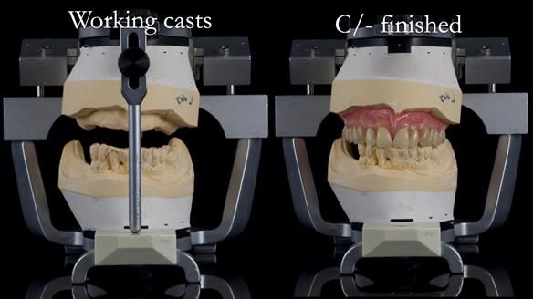 Newsletter 54 case presentation upper complete denture and lower Scandinavian designed hygienic partial denture for David