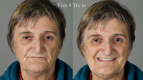 Newsletter 83: Sheila’s Complete Denture Success