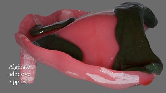 Newsletter 52 Managing Jo’s failing dentition with extractions and Mk 1/Mk 2 complete upper dentures and lower partial dentures FULL PROTOCOL