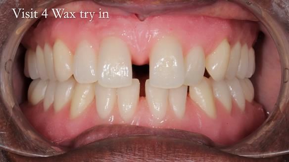 Newsletter 53 showing the making and fitting of ultra life-like dentures for Valena