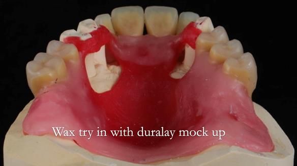 Finlay's Newsletter 59 Ultra hard partial dentures made for Gill