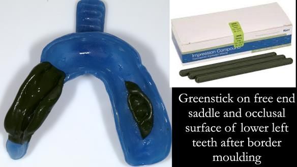 Finlay's Newsletter 61 provision of a lower unilateral free end saddle metal based partial denture for Joyce