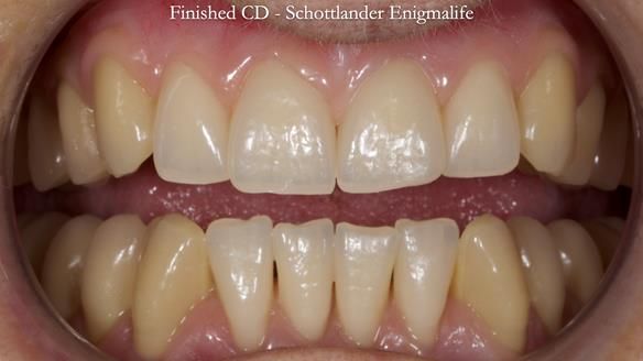 Newsletter 83: Sheila’s Complete Denture Success