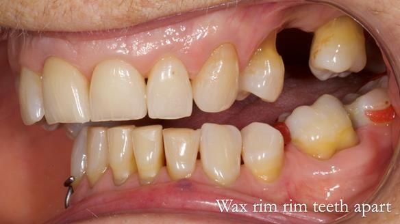 Finlay's Newsletter 61 provision of a lower unilateral free end saddle metal based partial denture for Joyce
