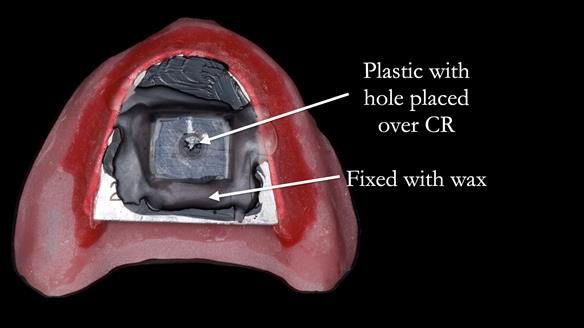 Newsletter 82 Mary - A complete upper and a one-tooth gasket denture