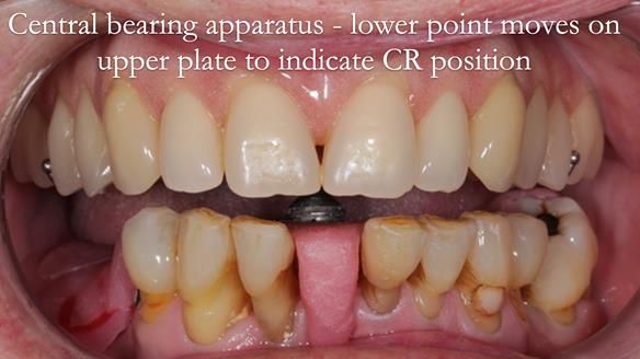 Newsletter 54 case presentation upper complete denture and lower Scandinavian designed hygienic partial denture for David
