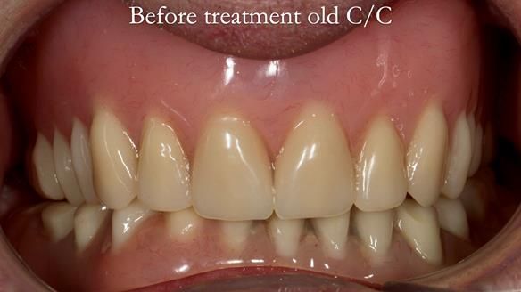 Complete denture Class II div 2 deep overbite Newsletter 39