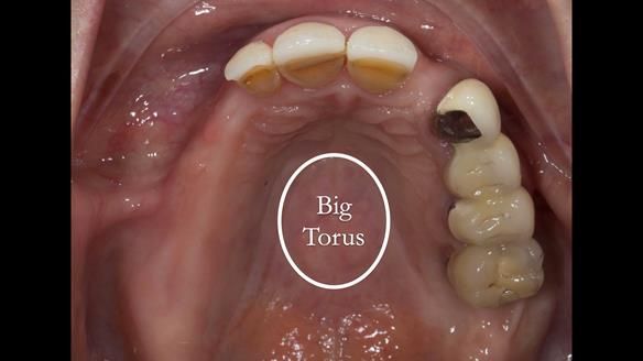 Newsletter 51 Managing Anne’s failing dentition with distal extension base RPD/Splint FULL PROTOCOL
