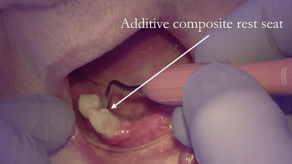 Finlay's Case Study Newsletter 40 - Immediate Mk 1 RPD to Definitive Mk 2 RPD - full protocol