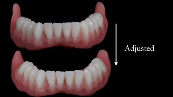 Newsletter 65 Marisa Provision of Complete Dentures on badly placed implants