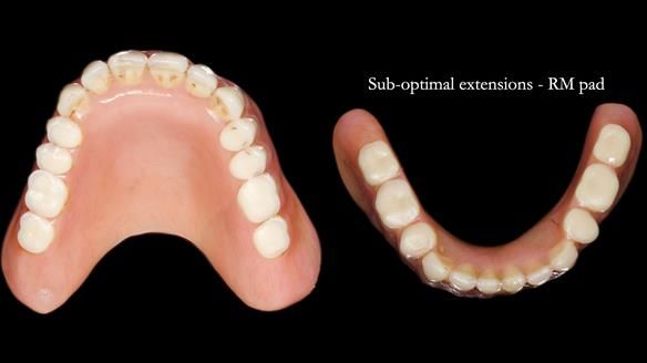 Newsletter 78: What do Clark Gable and a Locator® overdenture have in common?