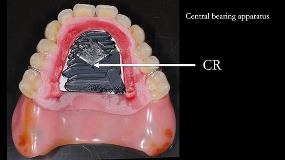 Newsletter 54 case presentation upper complete denture and lower Scandinavian designed hygienic partial denture for David
