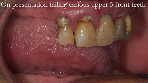 Finlay's Newsletter 62 provision of extractions and metal based complete dentures for Rafique