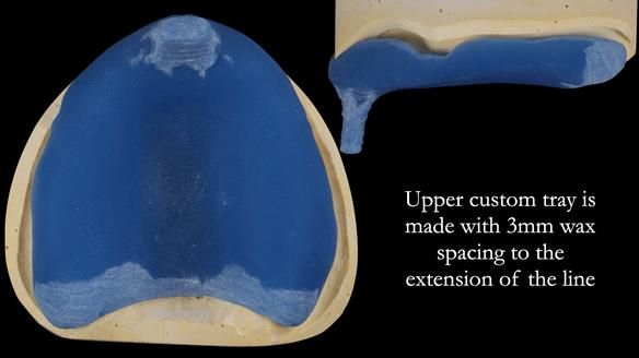 Newsletter 53 showing the making and fitting of ultra life-like dentures for Valena