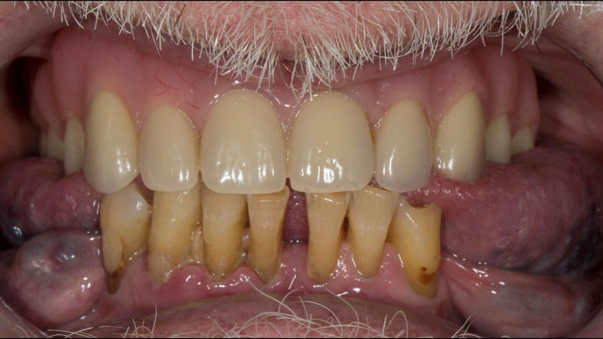 Newsletter 87 – Father Peter: A Partial Denture that needed Minor Miracle