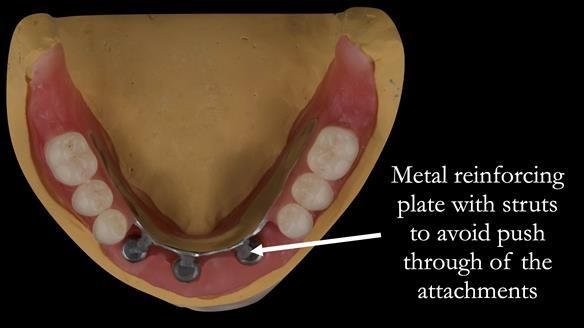 Reinforcement to implant supported dentures is crucial to reduced breakages